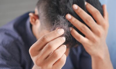 Is your diet causing your hair loss?